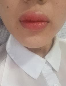 Lips during the initial healing phase with visible swelling starting to subside