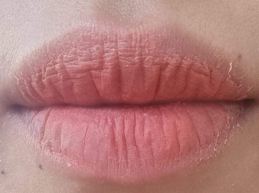Lips during scabbing and peeling phase of lipstick tattoo recovery