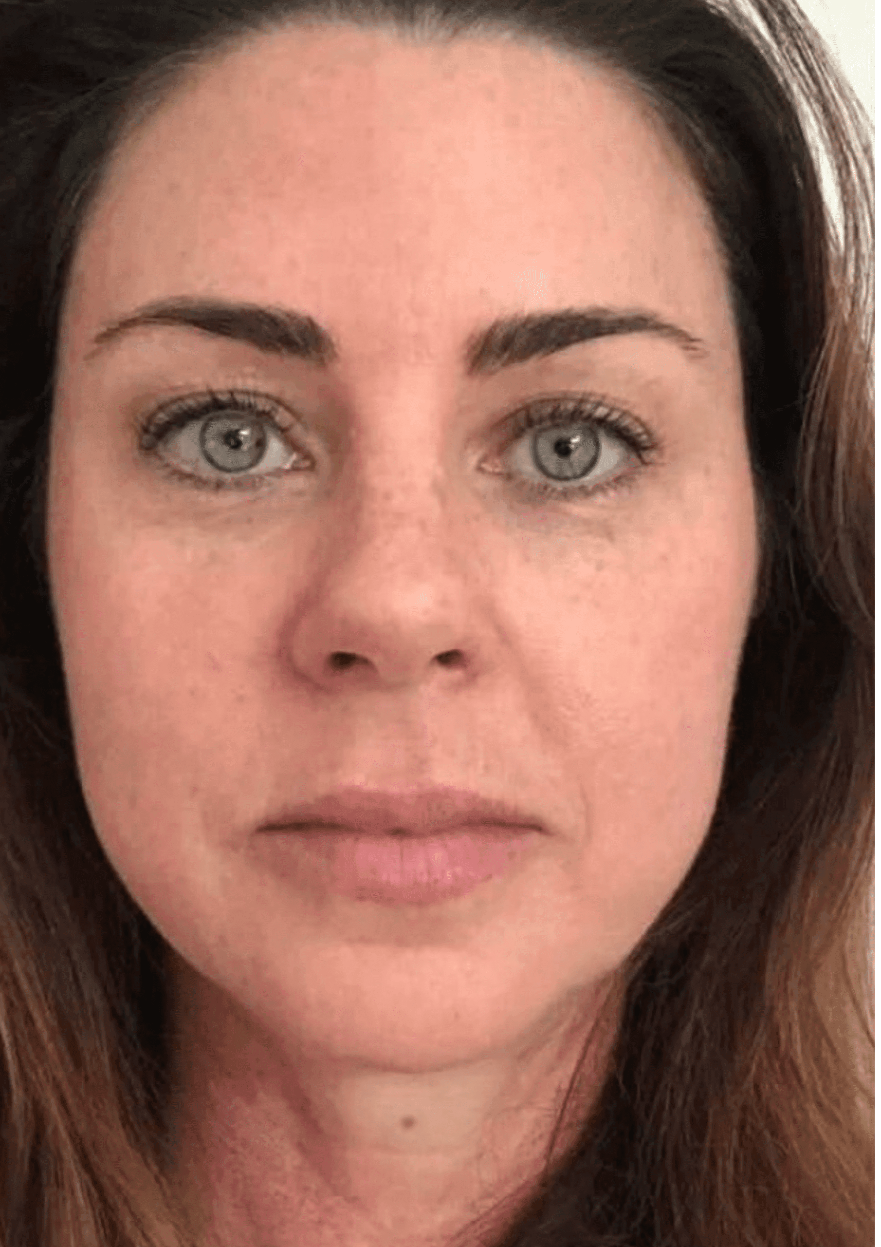 Louisa's skin before using the Qure Micro-Infusion System