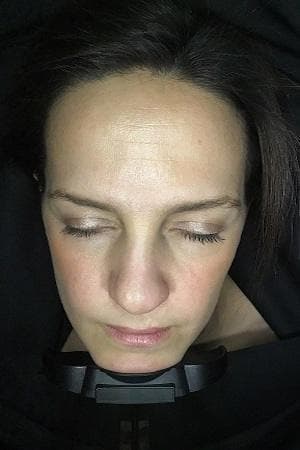 Jenna's Visia machine scan after eight weeks — smoother, more luminous