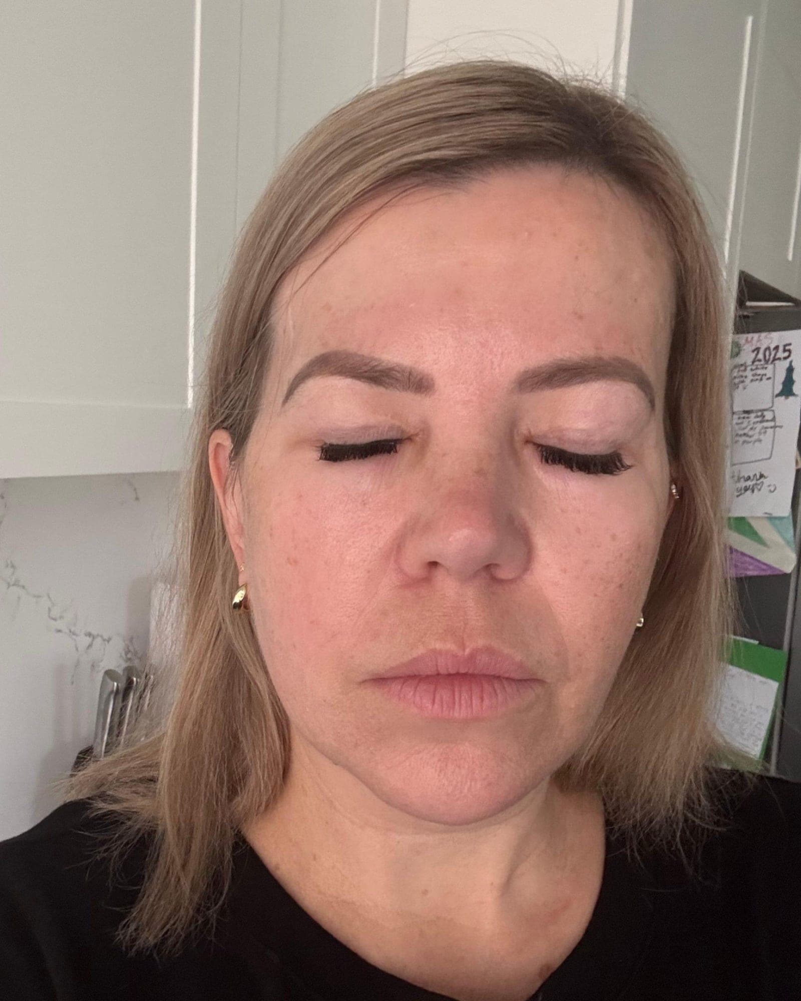 Ashleigh's skin after the trial showing improved tone and reduced pigmentation