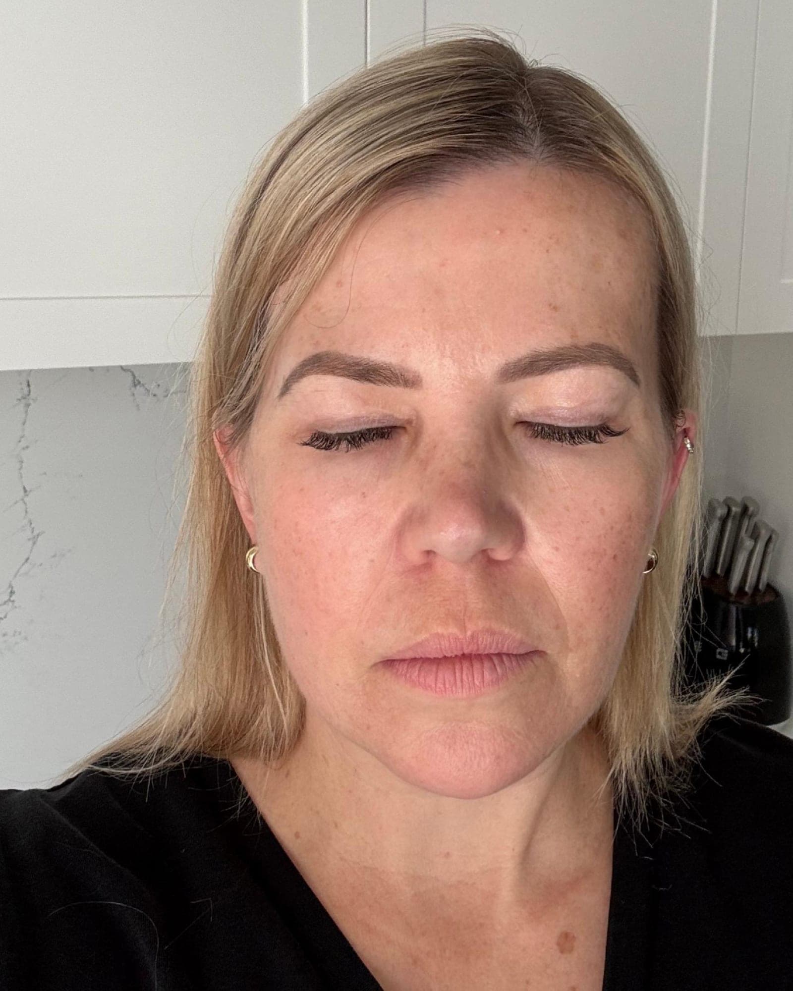 Ashleigh's skin before using Système Bio+ Oil Serum