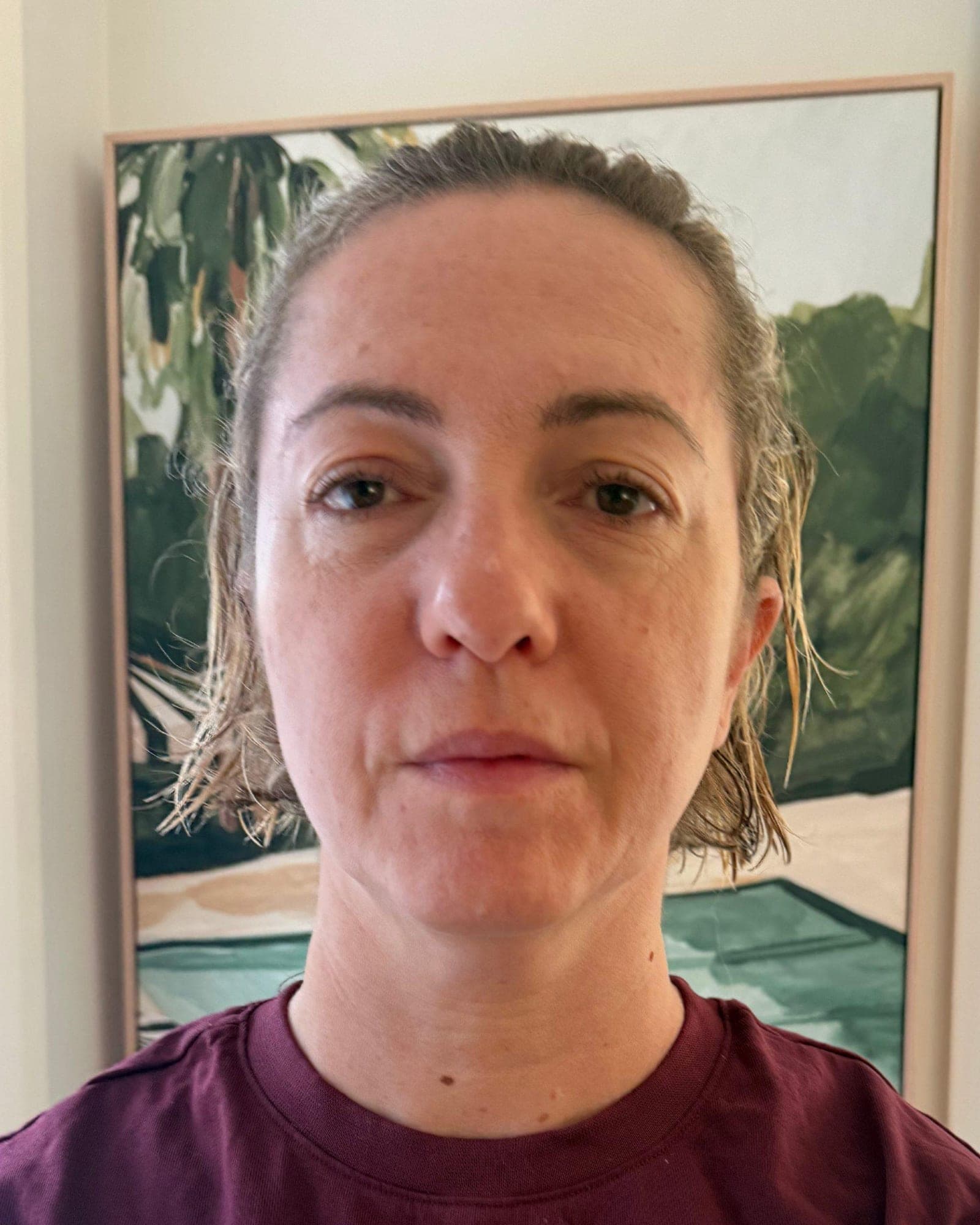 Katelyn's skin before using Système Bio+ Oil Serum