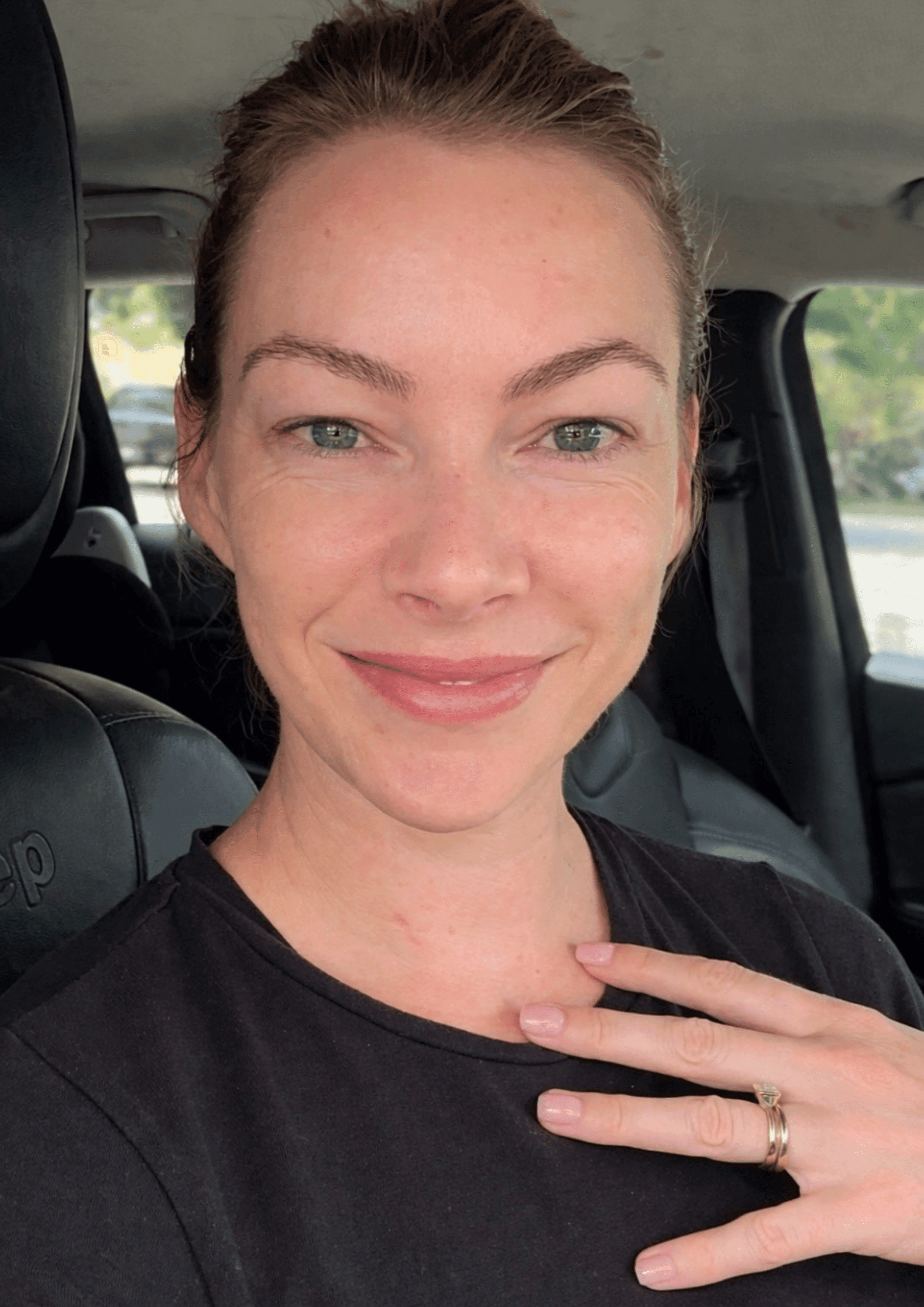 Simone's skin after two treatments showing improved glow
