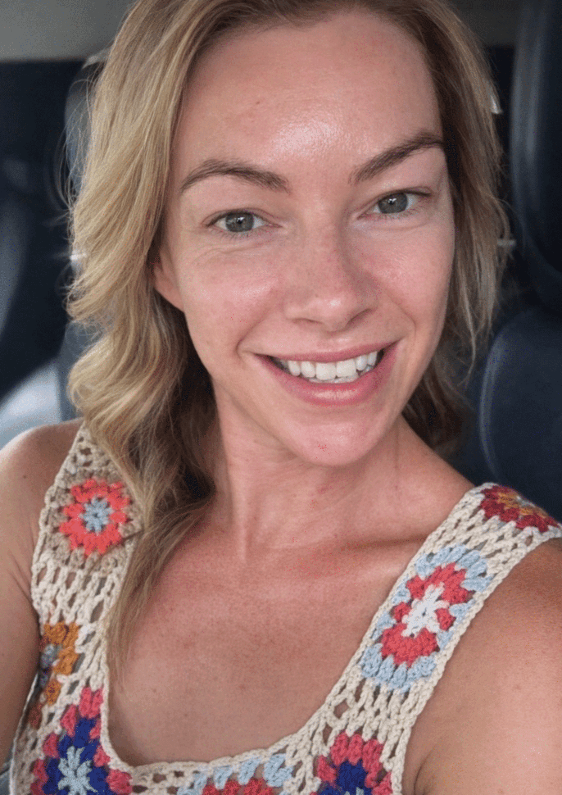 Simone's skin before using the Qure Micro-Infusion System