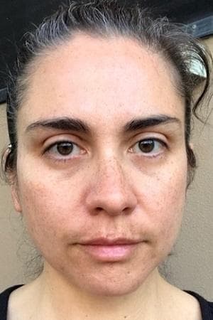 Katrina's skin after eight weeks — reduced pigmentation and clearer complexion