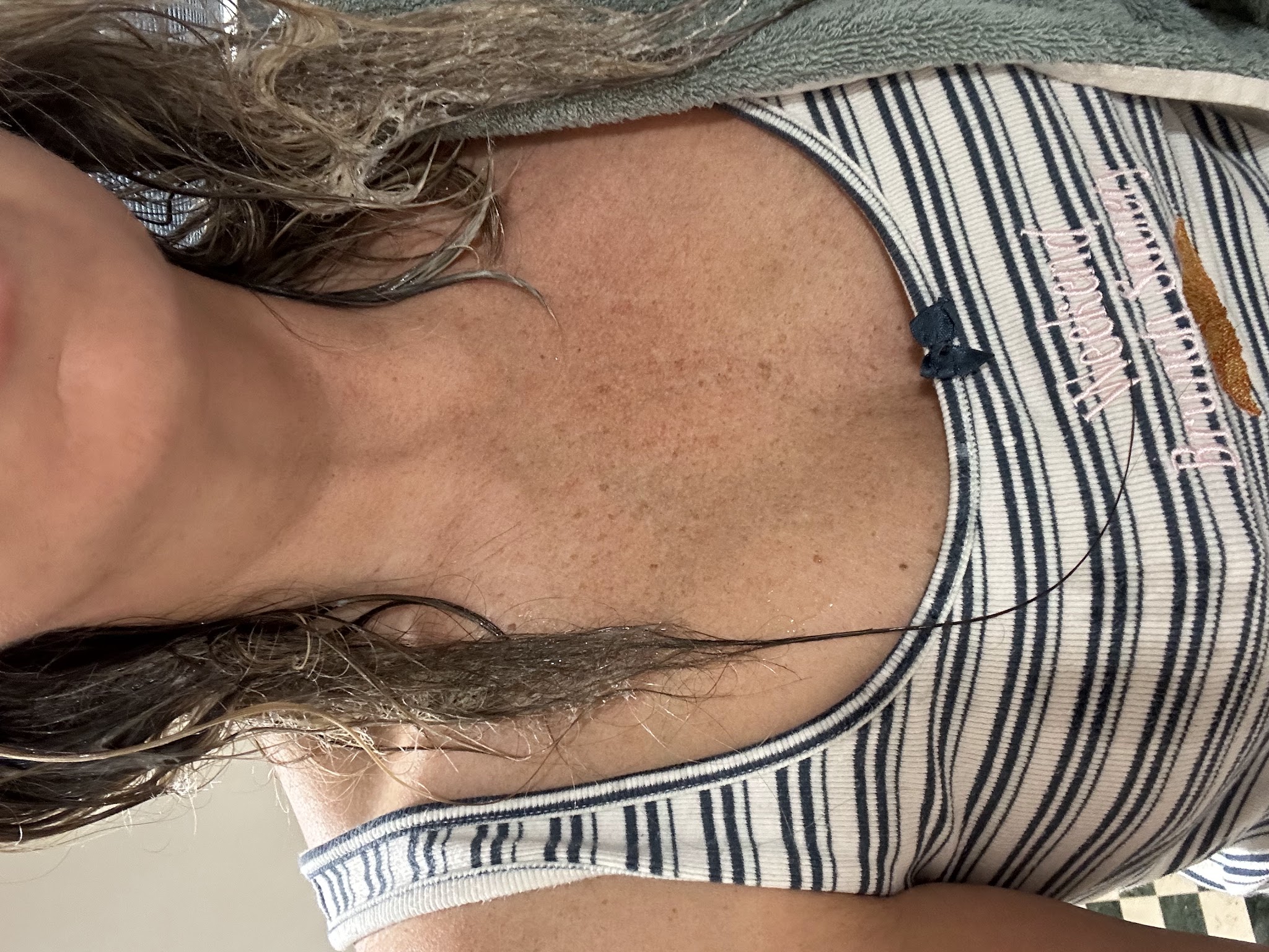 Colette showing her chest port and thinning hair during chemotherapy treatment, wearing a striped top